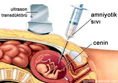 Amniyosentez testi