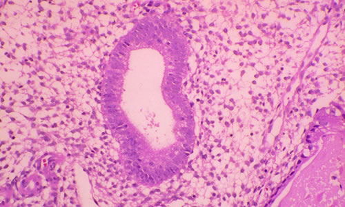 Endometrial Hiperplazi Belirtileri