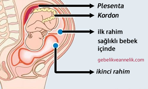 Çift Rahimle Hamilelik