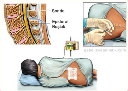 epidural anestezi