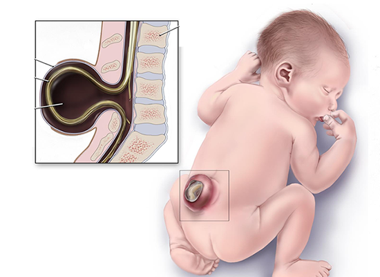 Spina Bifida Belirtileri Nelerdir?