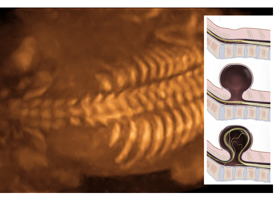 Spina Bifida Cesitleri Nelerdir?