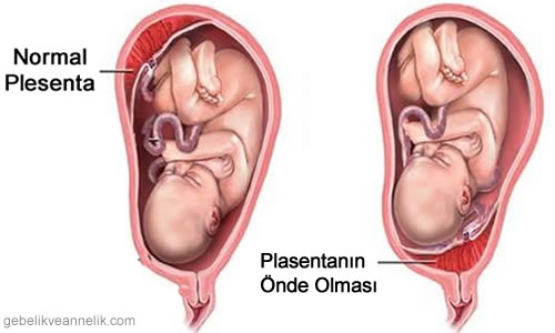 Plasentanın Önde Olması Tedavi