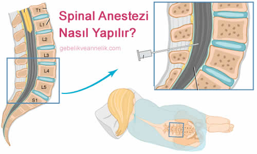 Spinal Anestezi Nasıl Yapılır?