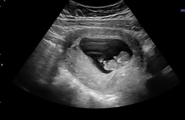 10. Hafta Anne Karnı Bebek Ultrason Görüntüleri