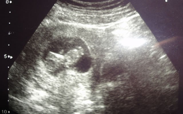 10 Haftalık Bebek Ultrason Görüntüleri