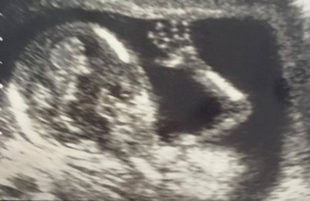 12 Haftalık Erkek - Kız Bebek Ultrason Görüntüsü