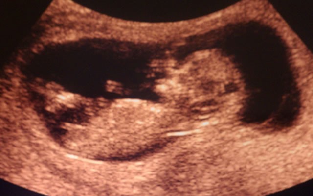 12 Haftalık Bebek Ultrason Görüntüleri