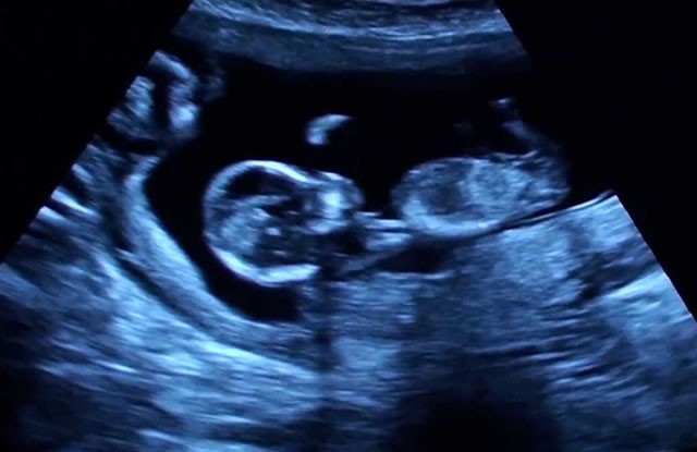 12 Haftalık Erkek - Kız Bebek Ultrason Görüntüsü