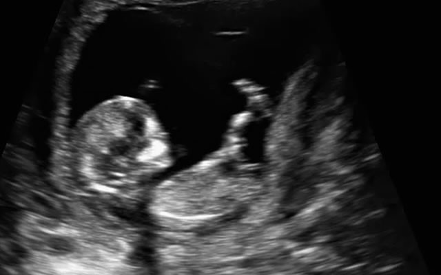 12 Haftalık Bebek Ultrason Görüntüleri