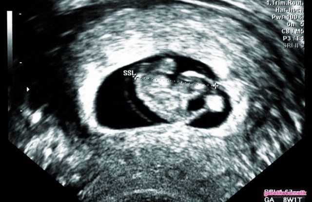 8. Hafta Anne Karnı Bebek Ultrason Görüntüleri