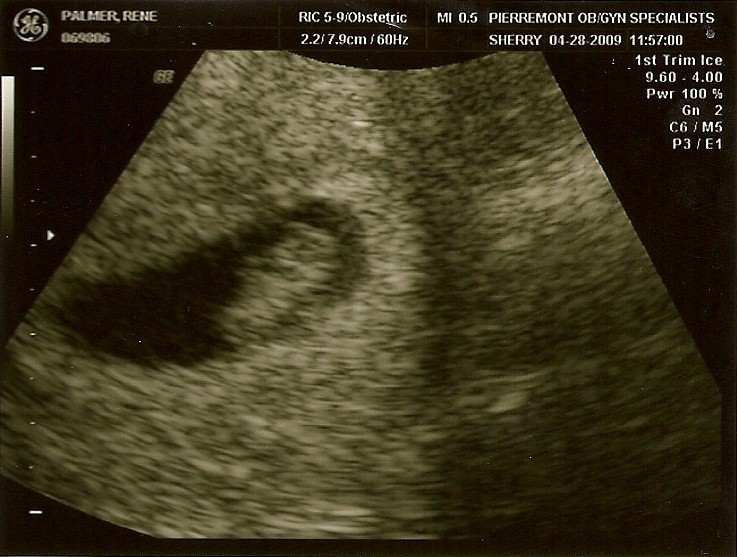 8. Hafta Anne Karnı Bebek Ultrason Görüntüleri