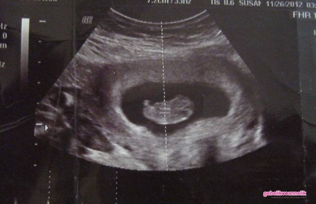 9. Hafta Anne Karnı Bebek Ultrason Görüntüleri
