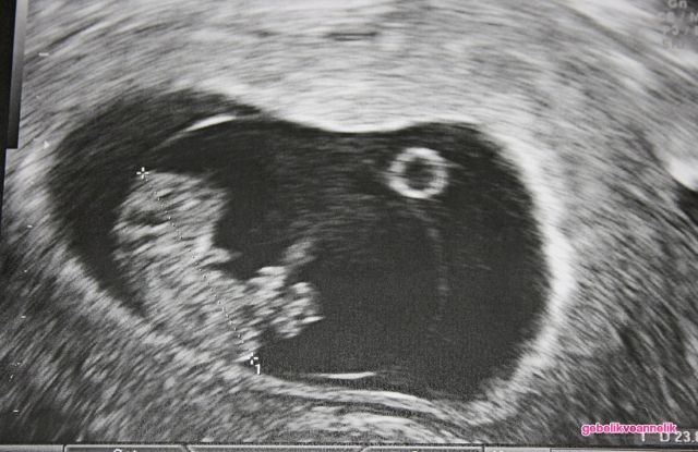 9. Hafta Anne Karnı Bebek Ultrason Görüntüleri