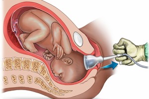 Vakum ile Doğum Nedir?